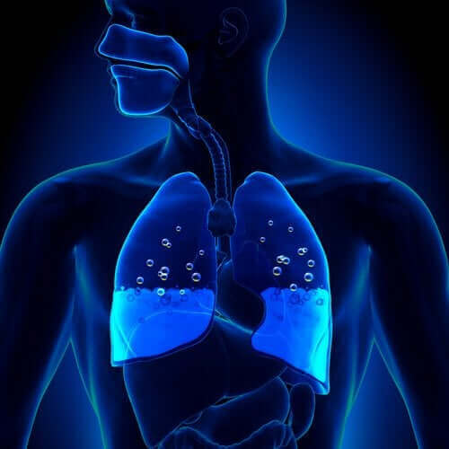 What is pulmonary oedema?